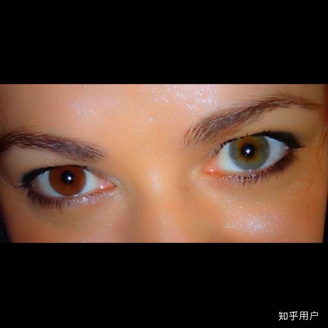 虹膜异色症是种怎样的体验? - 知乎