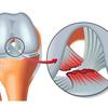 膝关节韧带损伤acl Pcl Mcl Lcl 知乎