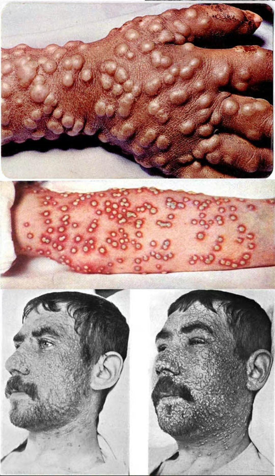  疫情变异人会有哪些症状(病毒变异最终会变成什么样)