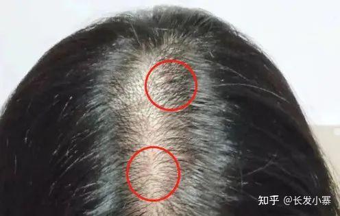 头皮长痘痘该如何正确处理? - 知乎