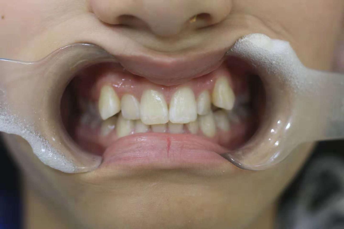 只有门牙龅牙怎么矫正（被人取笑龅牙？矫正可以帮你颜值提升，但要知道这2个矫牙黄金期） | 说明书网