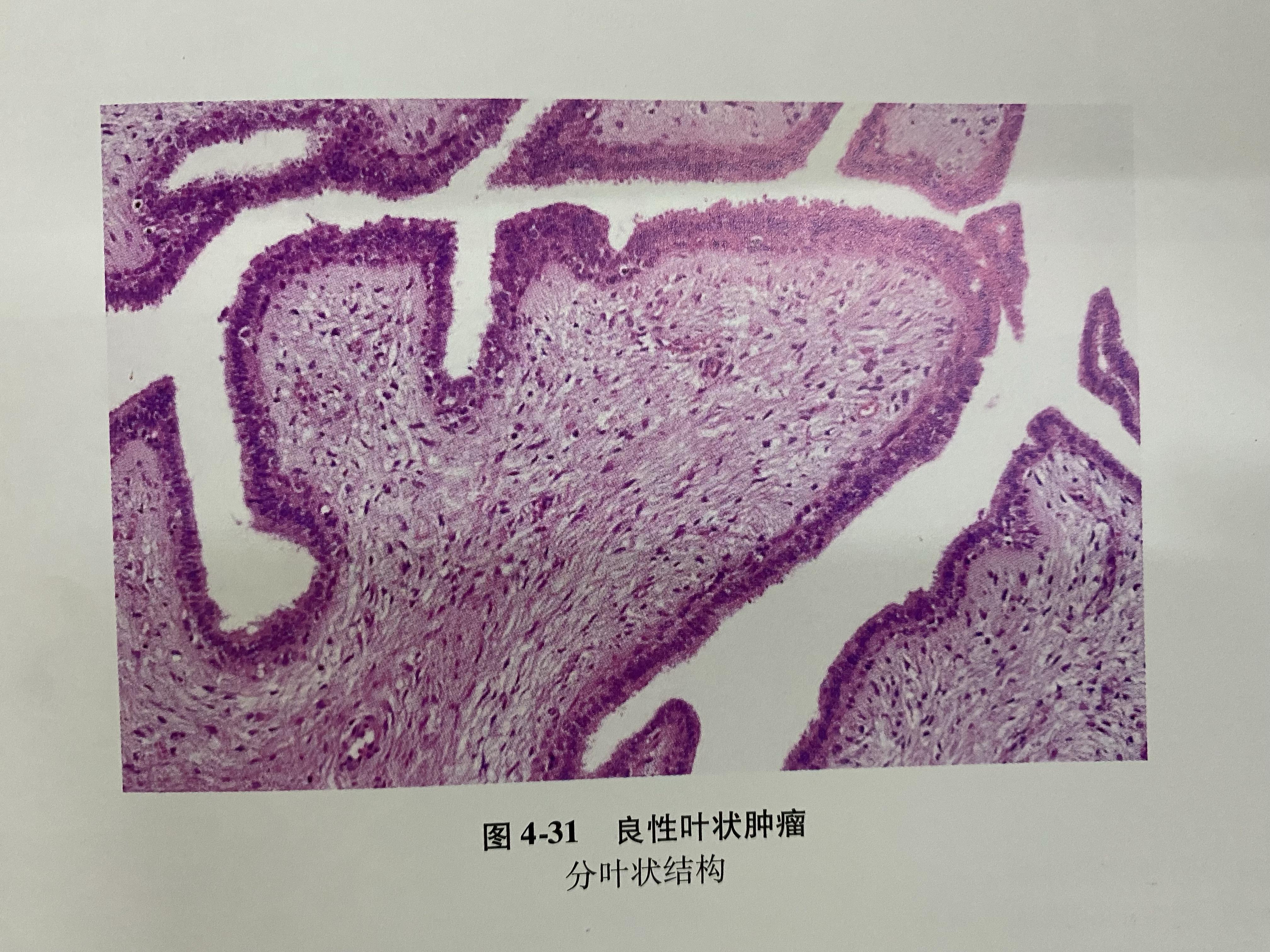 乳腺纤维瘤分叶状图片图片