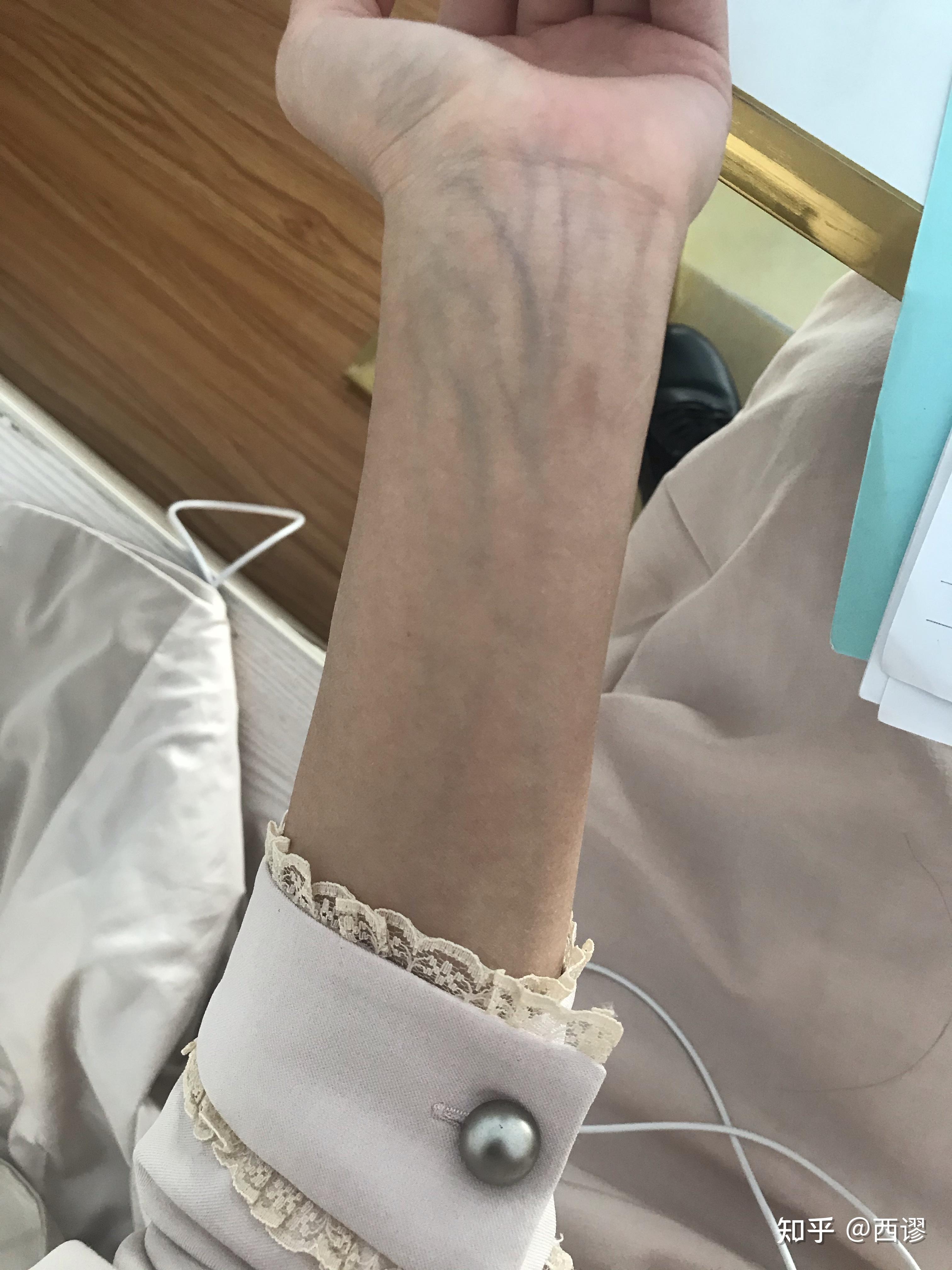 手腕上静脉颜色很明显,是身体有什么病症的原因吗? - 知乎