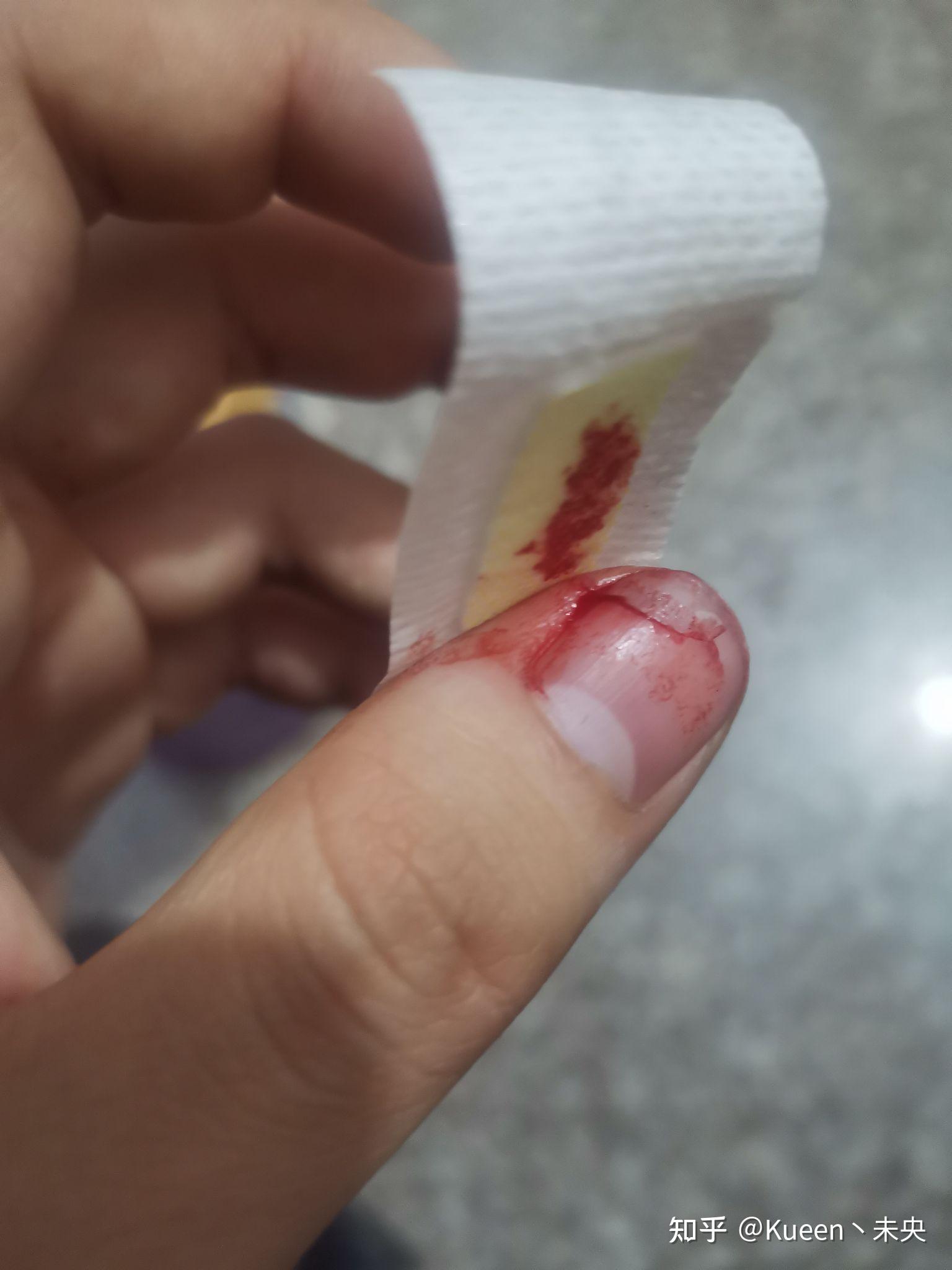 指甲从中间断了 怎么快速愈合? - 知乎