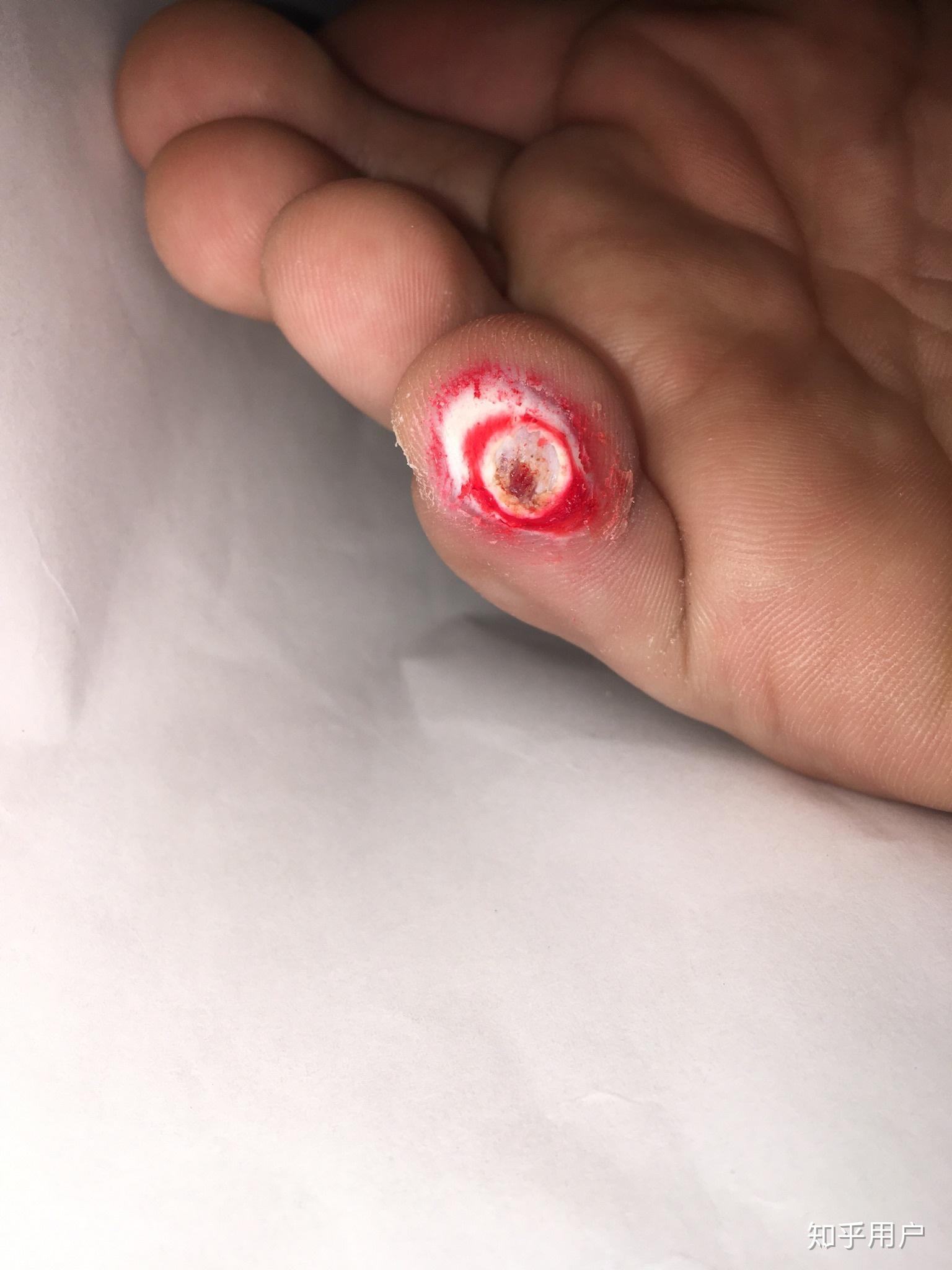 鸡眼怎么彻底挖出? - 知乎
