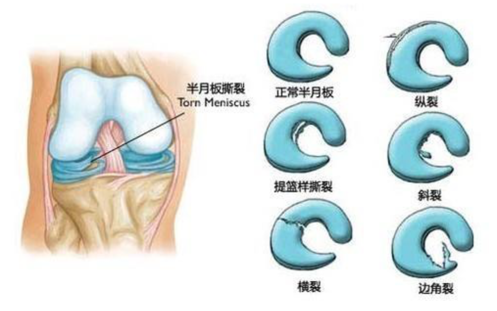 半月板损伤康复 半月板之 殇 知乎 半月板损伤康复 半月板之 殇 知乎