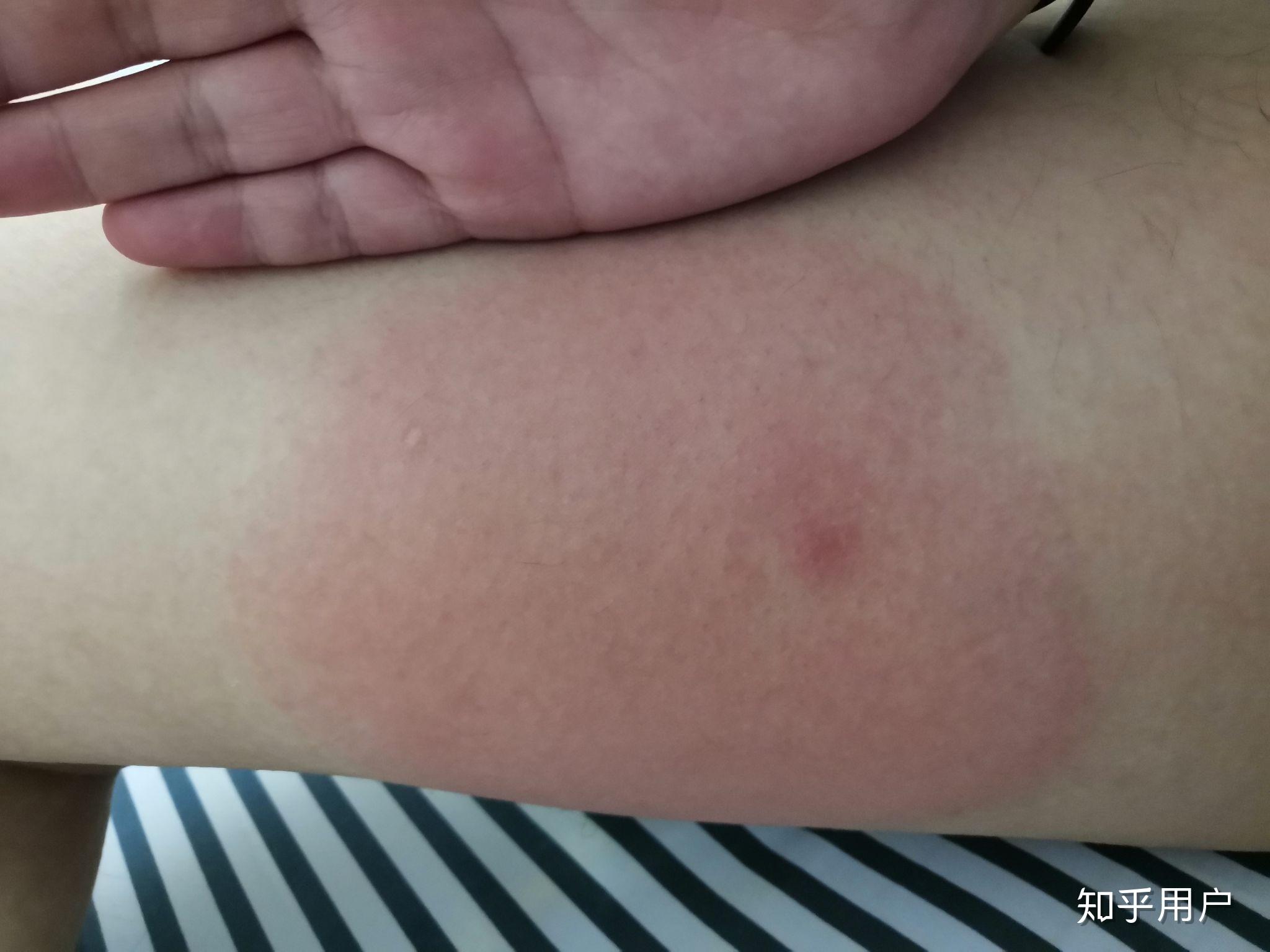 被虫子咬了红肿一大片好像有扩张的迹象很痒温度比其他地方高怎么治疗