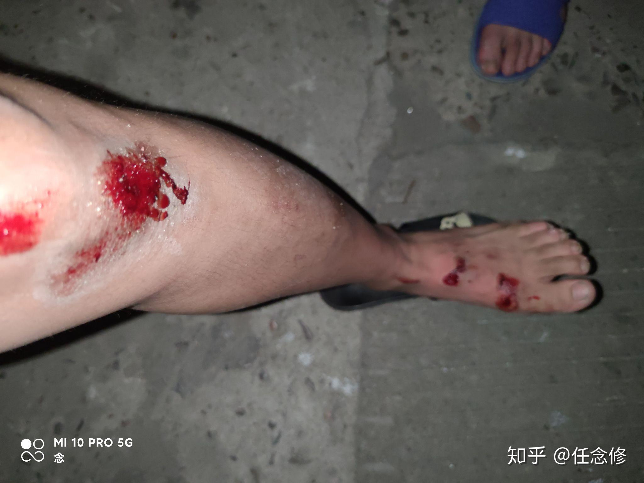 男生膝盖摔伤流血照片图片
