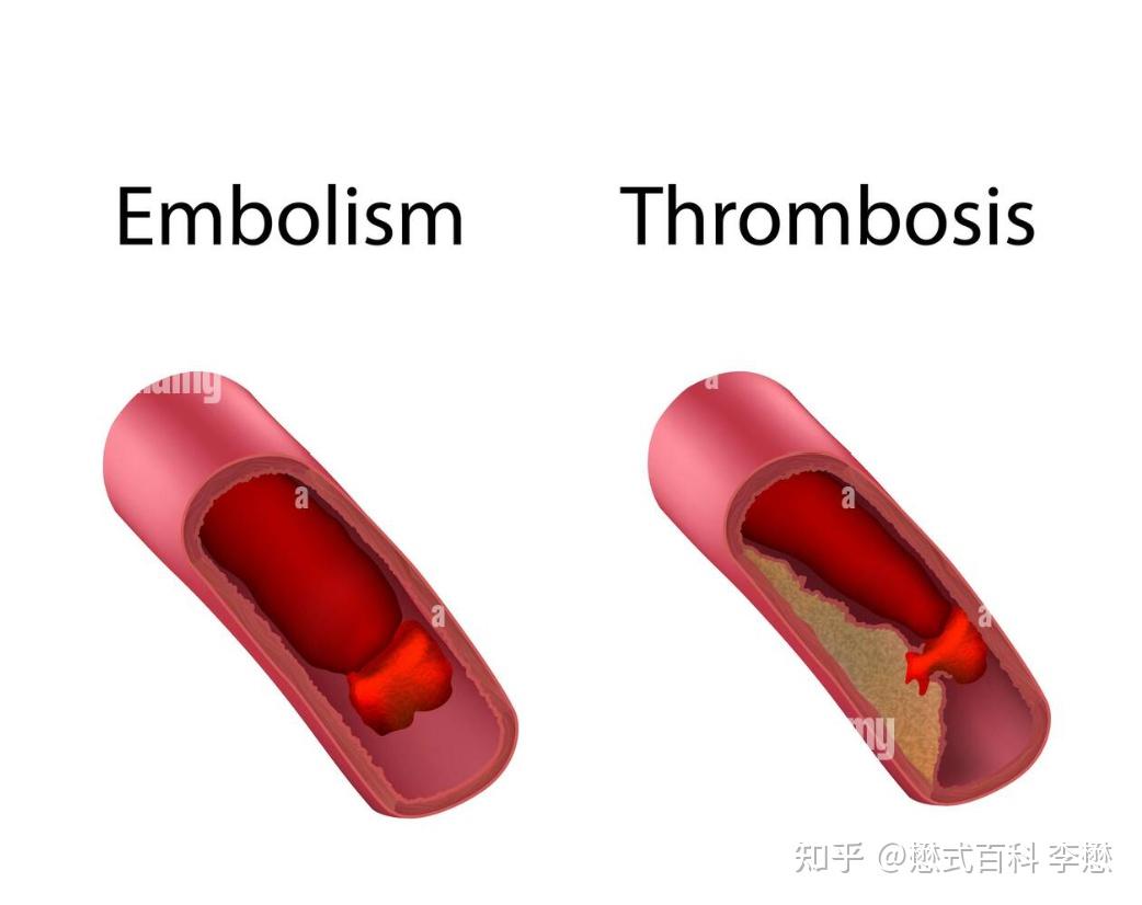 血栓形成、栓塞以及梗死之间有何联系? - 知乎