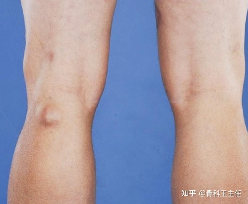膝盖上长了个鼓包,但是不疼,想知道这是什么原因,谢谢各位大神?