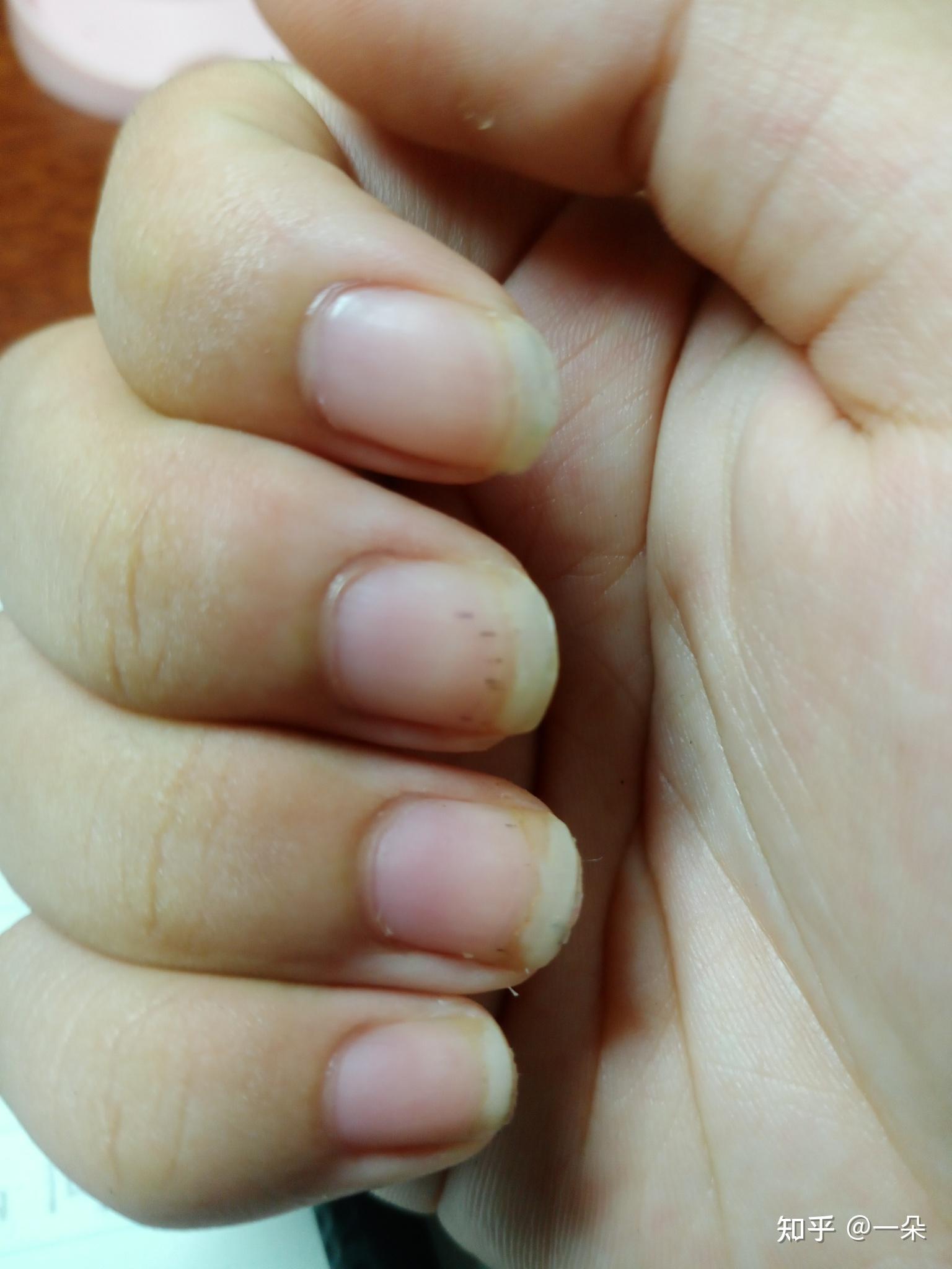 好几个指甲盖上长了黑色的小点这是怎么回事啊