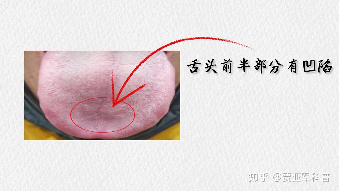 气虚怎么补?舌象告诉你答案,医生教你如何正确调理五脏气虚 - 知乎