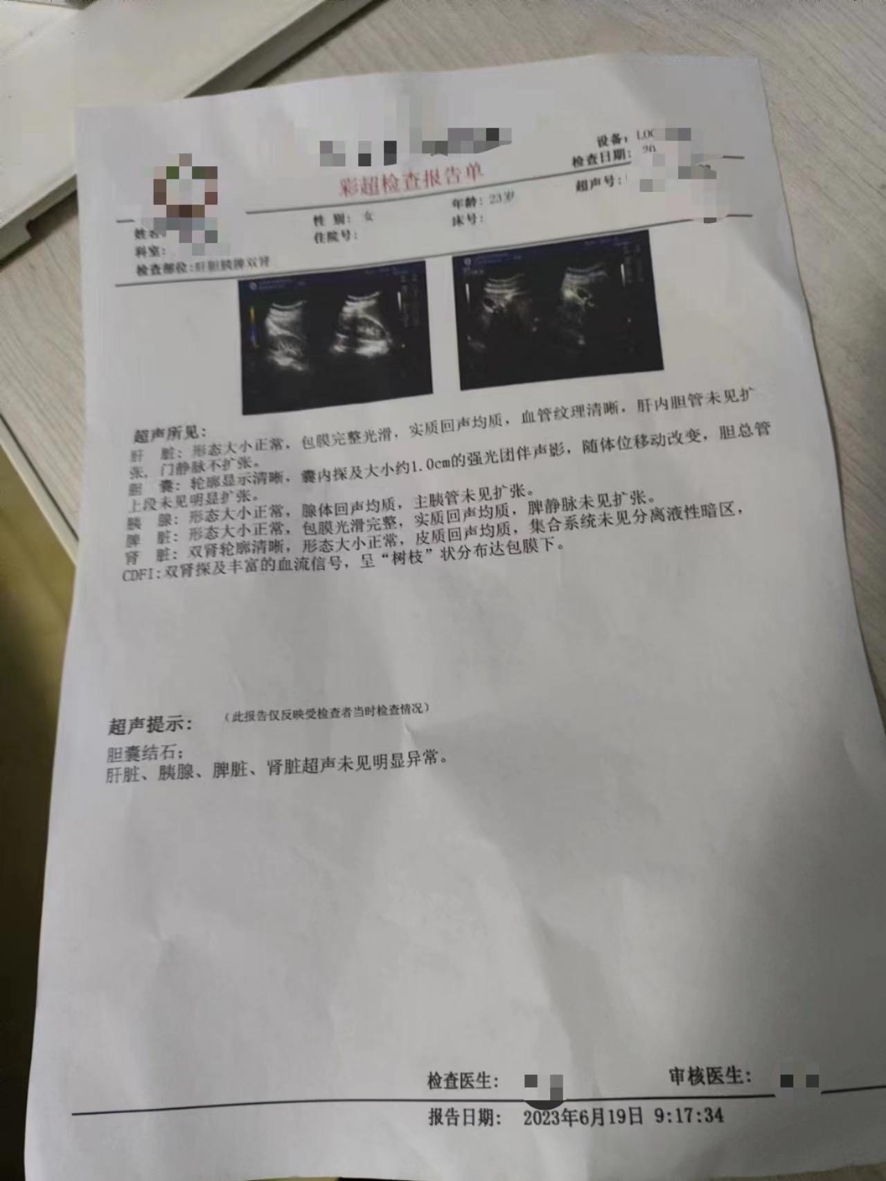 小小胆囊结石