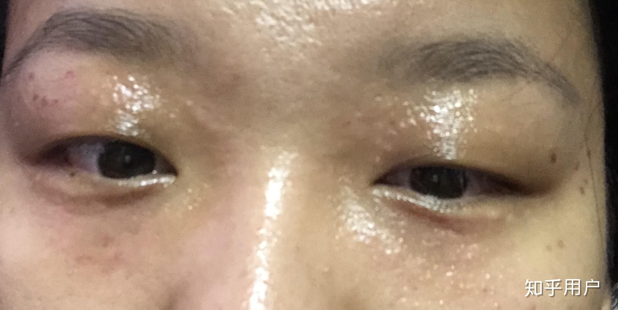 眼睛周围长了很多汗管瘤,怎么办? - 知乎