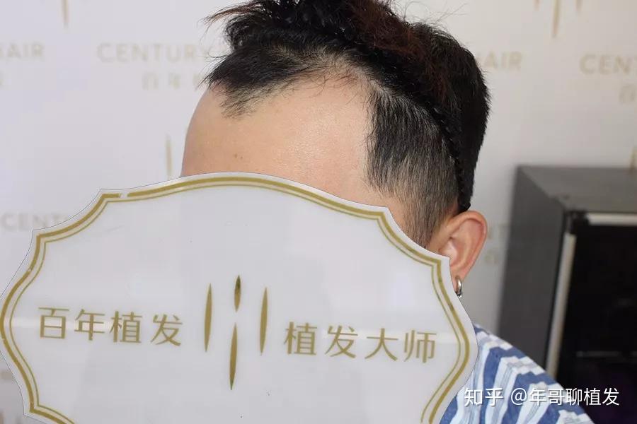 【无锡植发】种植密度如何算?额角种植2500单位彻底摆脱M秃 - 知乎