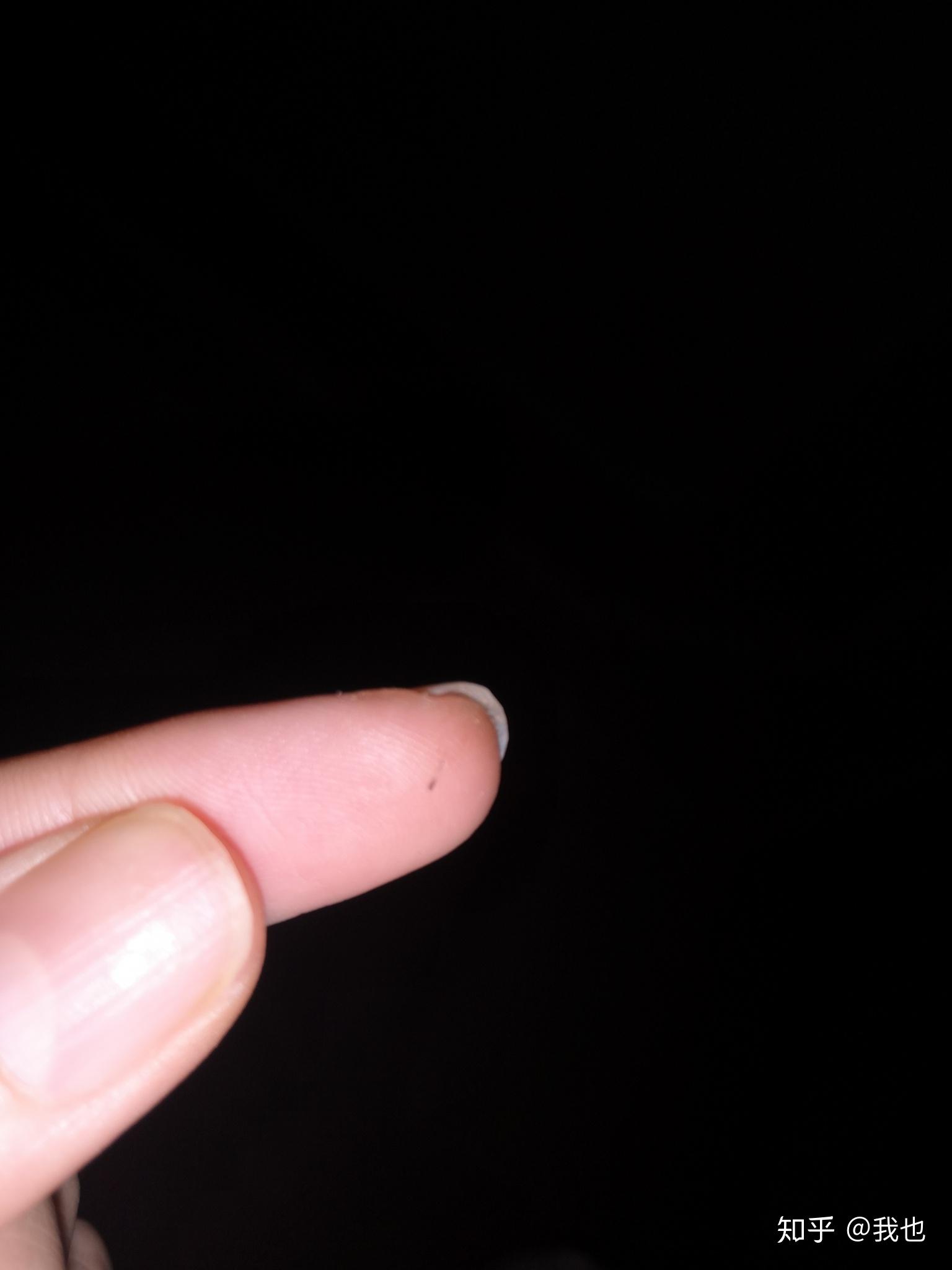 问问大家伙们,身上有没有长过这种黑粗硬的毛,通常长在后背上的?