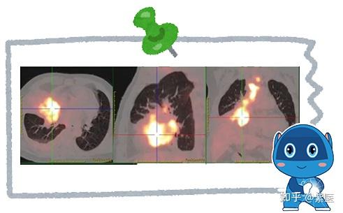 有核不懂 | 揭秘PET/CT报告中的“亮点”真相 - 知乎
