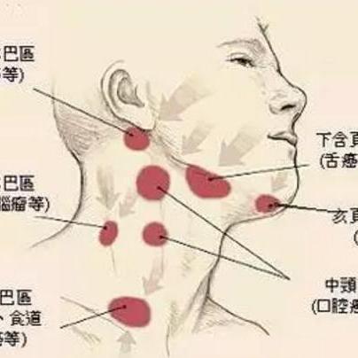 頜下淋巴結腫大壓痛