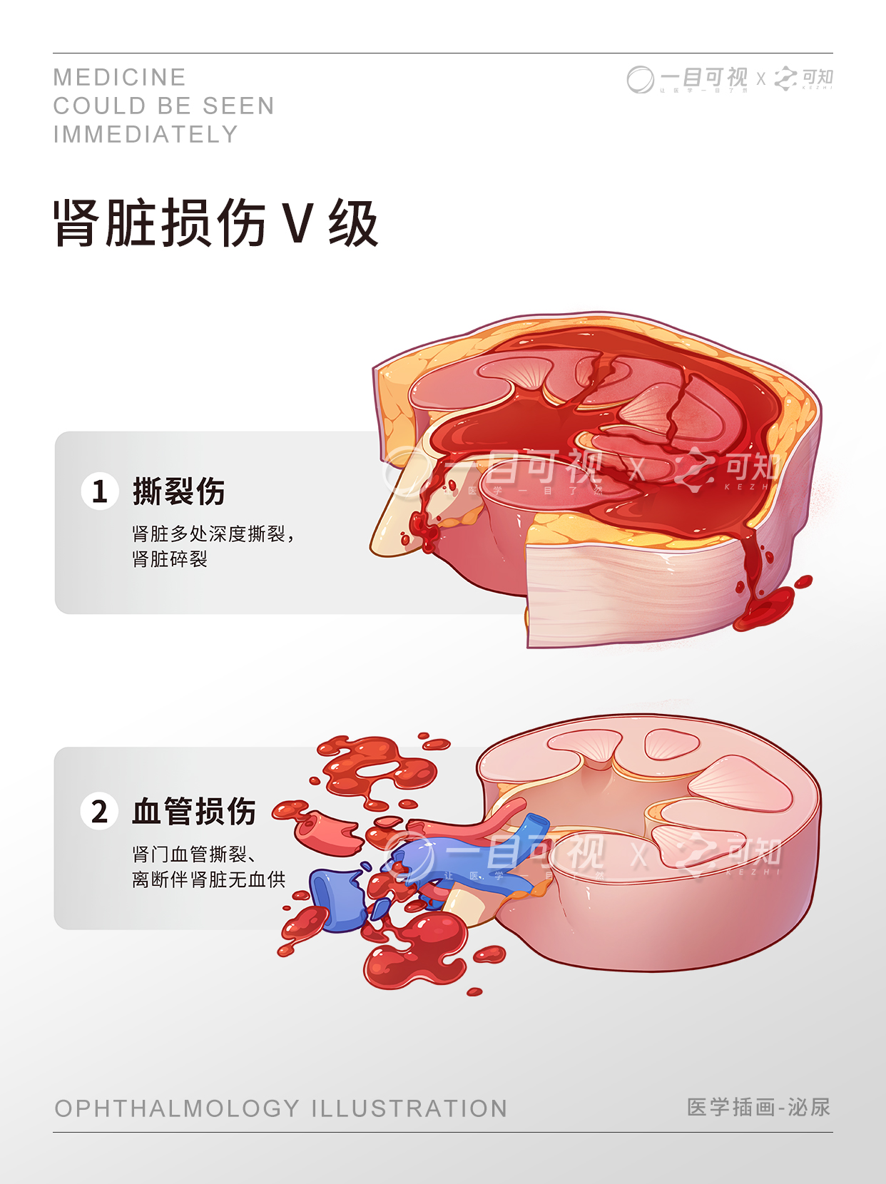泌尿系统 | 肾脏损伤分级 - 知乎