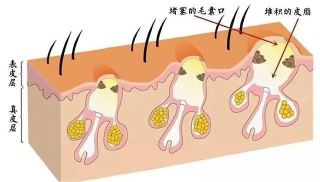 警惕!毛囊炎也会发展成疤痕疙瘩! - 知乎