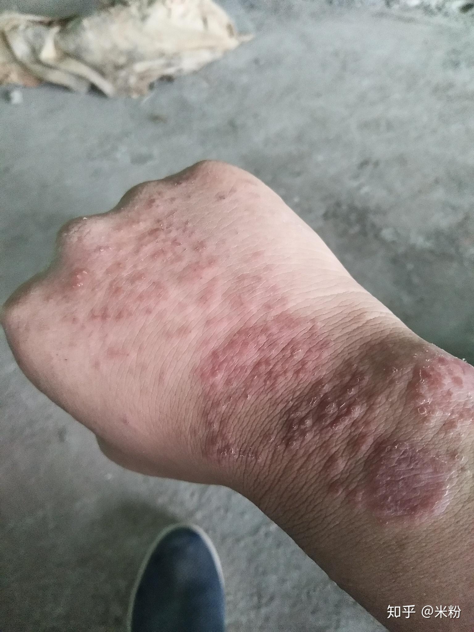 手上湿疹怎么根治