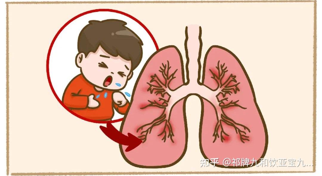 孩子支气管炎反复太难治 这2个方法可有效干预！ - 知乎