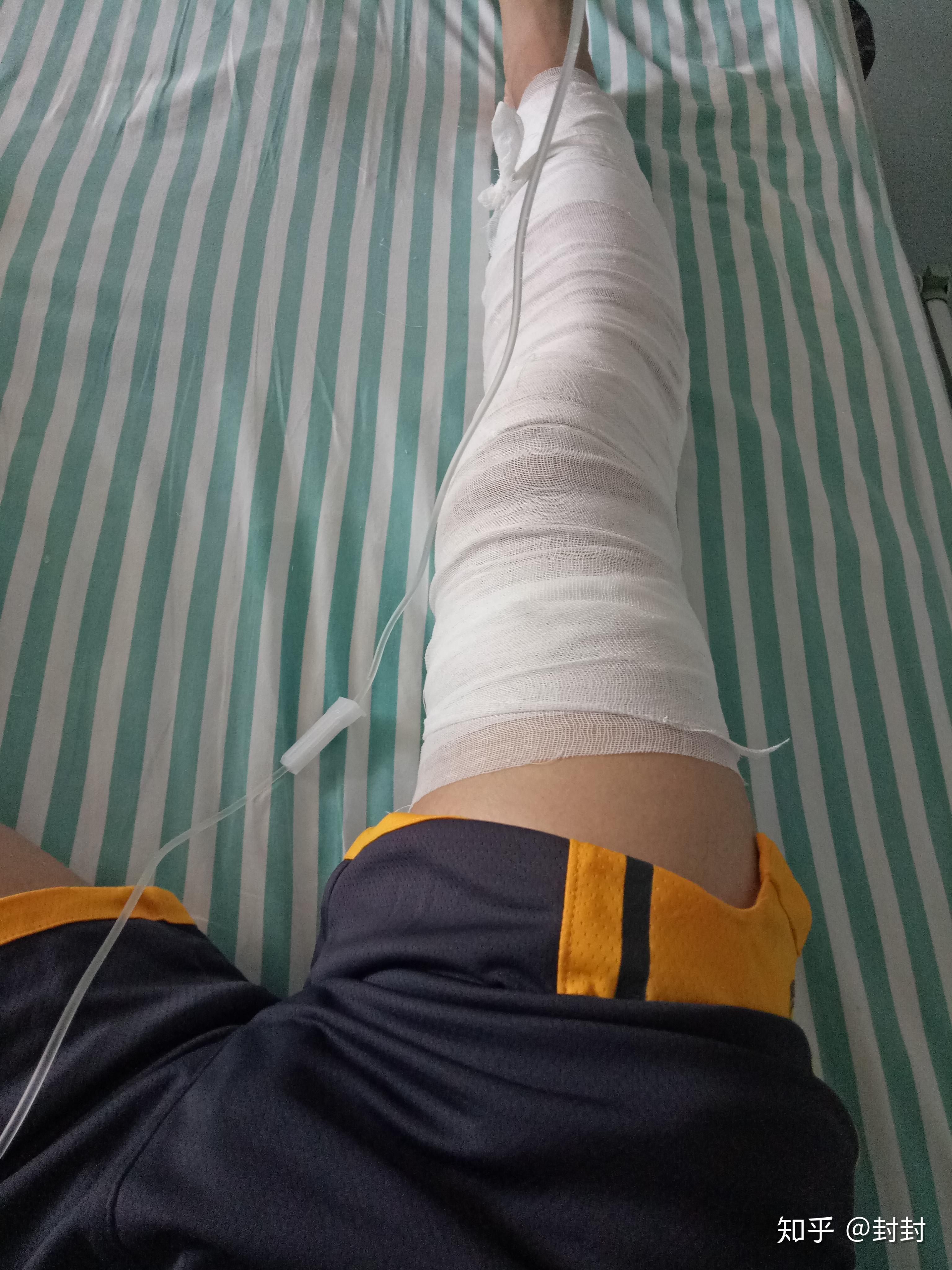 膝盖前交叉韧带断裂是一种什么样的体验? 