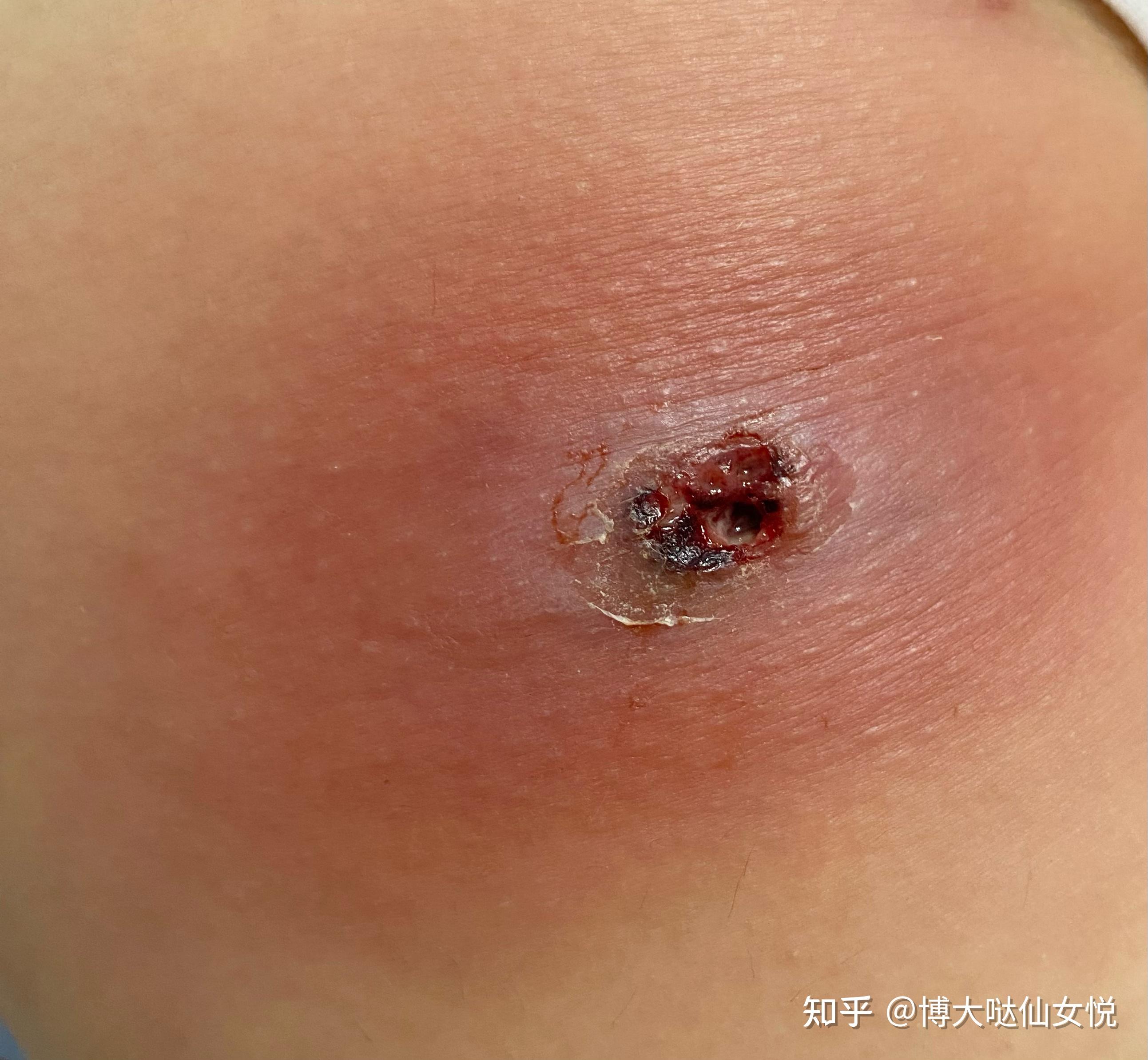 屁股上长个火疖子是什么感受  ?