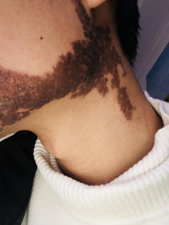 大家对身上有较大面积胎记的人怎么看待