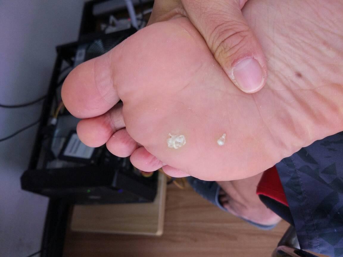 脚上的茧子怎么去掉