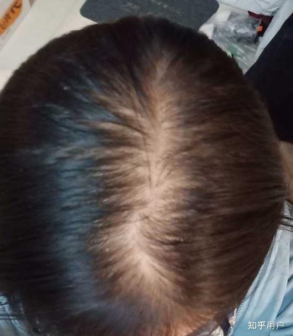 女生秃顶是怎样的体验