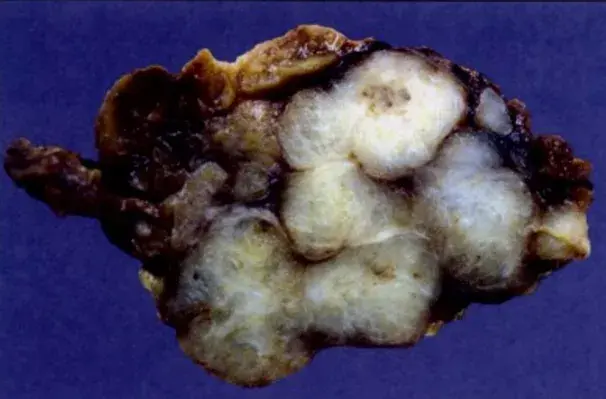 多形性腺瘤的病理诊断：深度解析 - 知乎