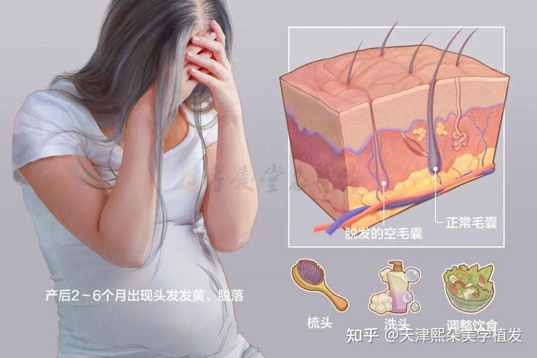 生完孩子为什么会脱发