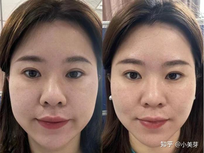 抗衰你还敢打超声炮吗?(包含超声炮效果、价格、案例、医生) - 知乎