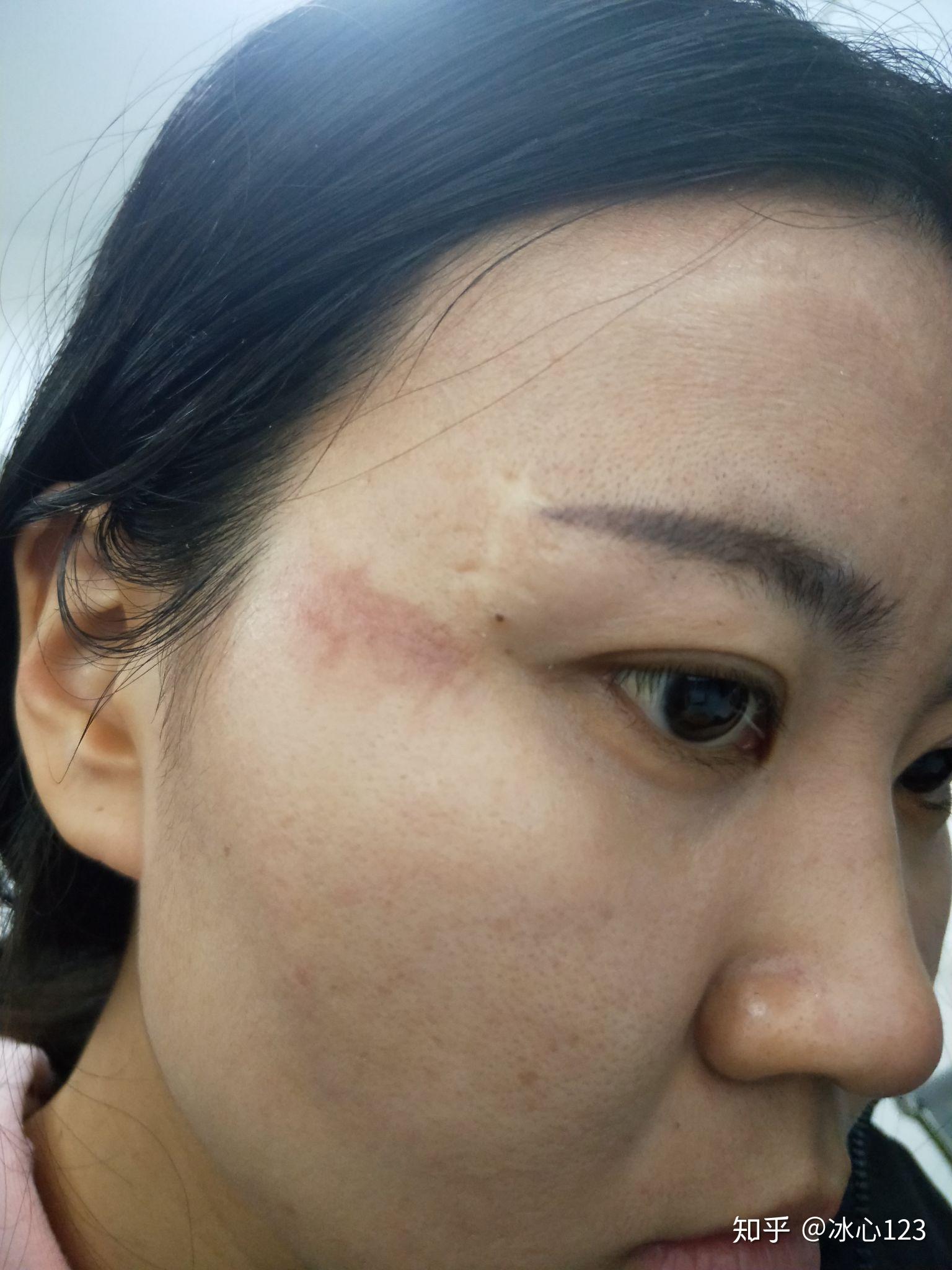 脸部擦伤如图请问如何恢复