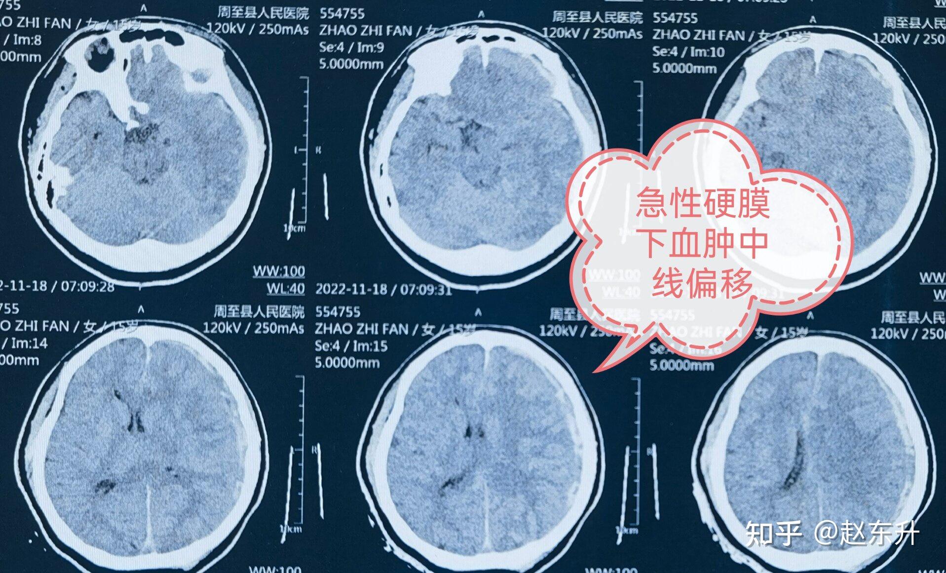 【疾病百科】放射性脑干损伤——早发现早治疗 - 脑医汇 - 神外资讯 - 神介资讯