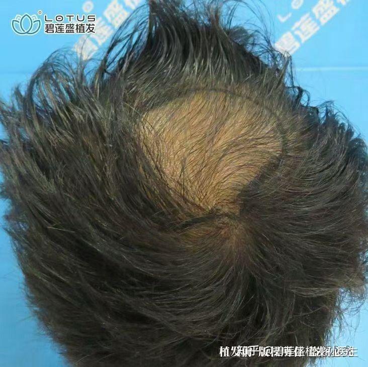 只发6个月的效果。 - 知乎