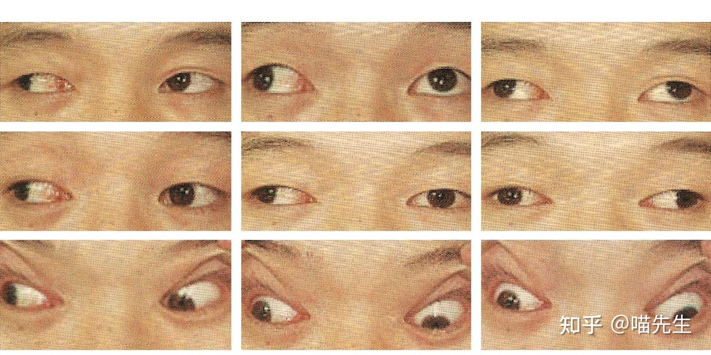 内直肌麻痹 - 知乎