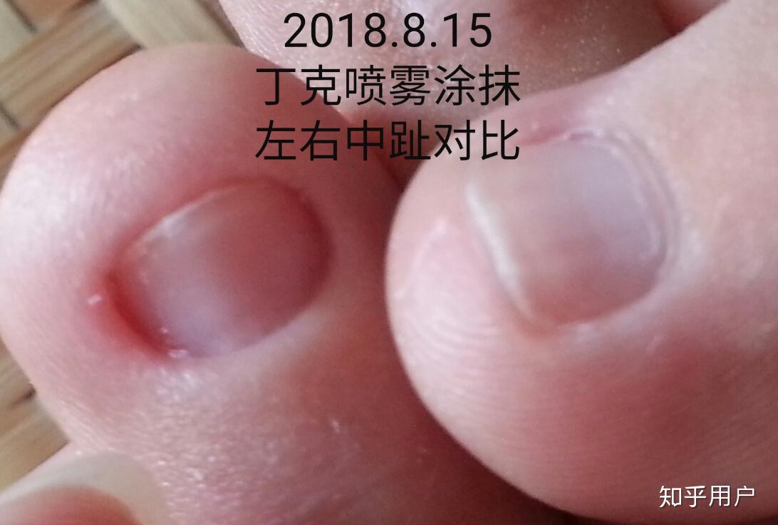 怎樣治療灰指甲