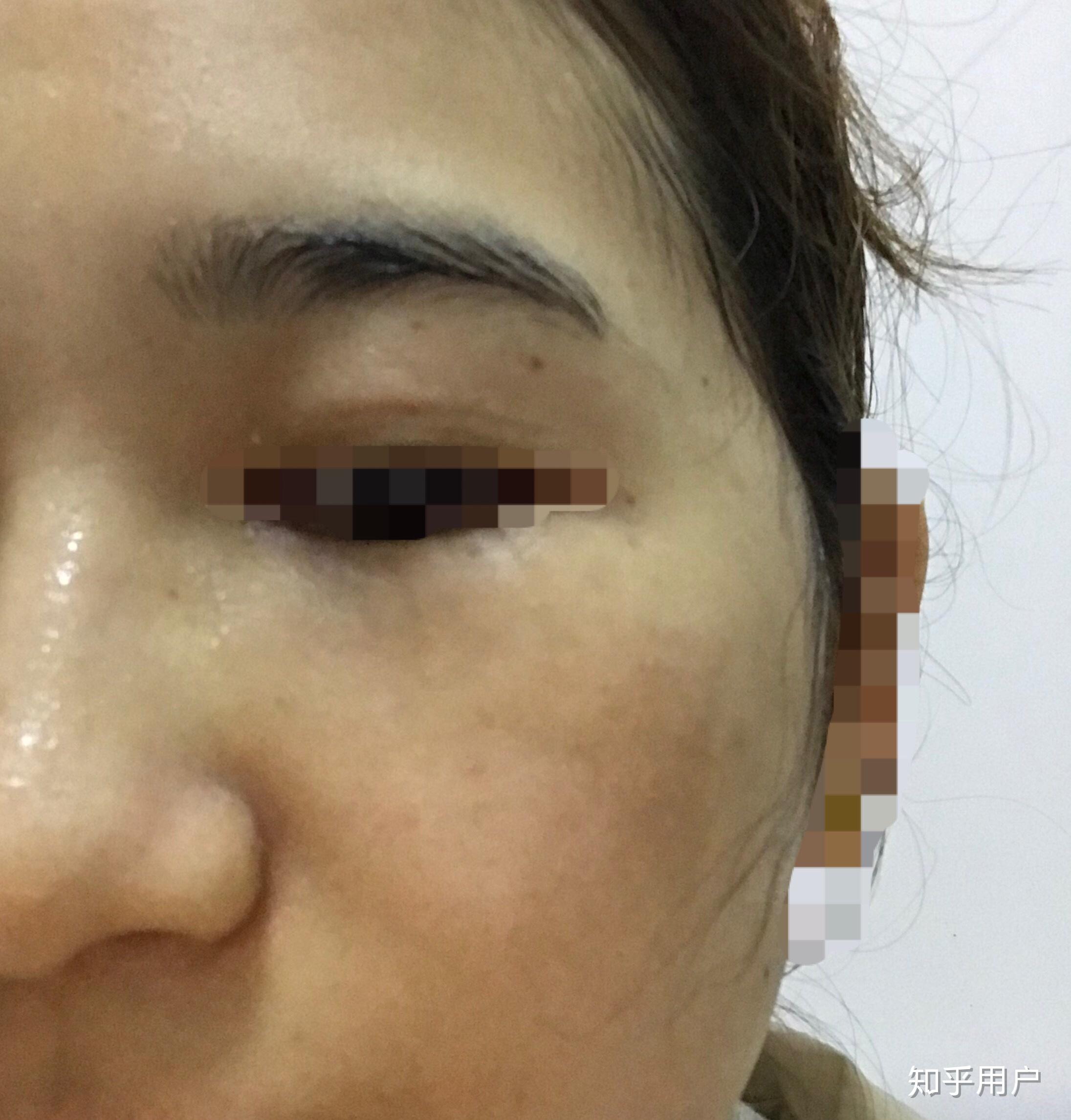 问一下我是褐青色痣轻度,我在重庆想激光祛除,有没有推荐的医院啊 ?