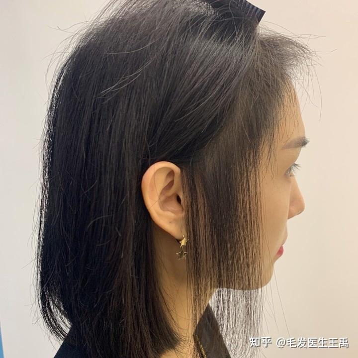 丝倍梵植发王禹:植发真的靠谱吗? - 知乎