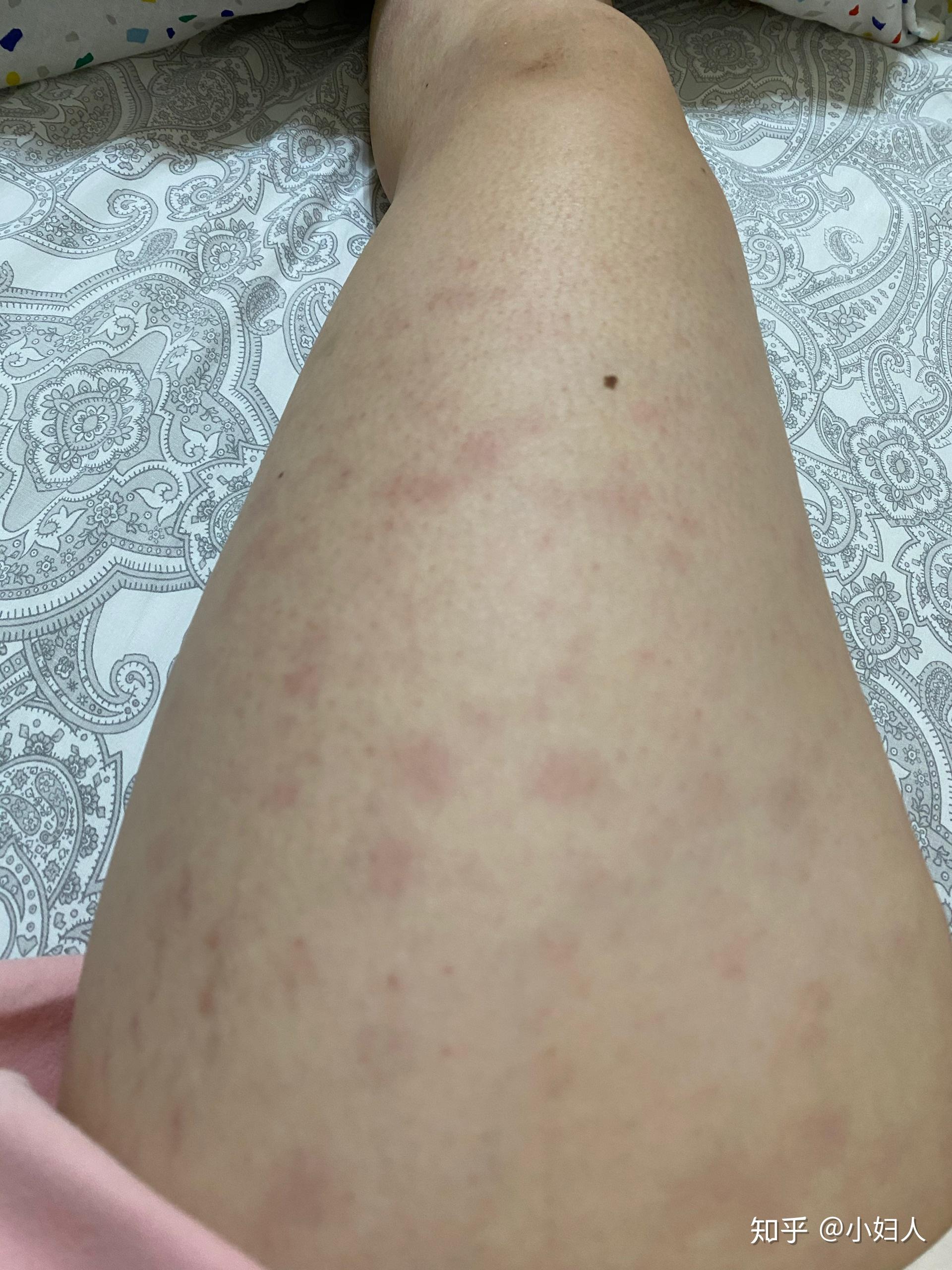 荨麻疹血管炎是很严重的病吗有得同样病的人吗