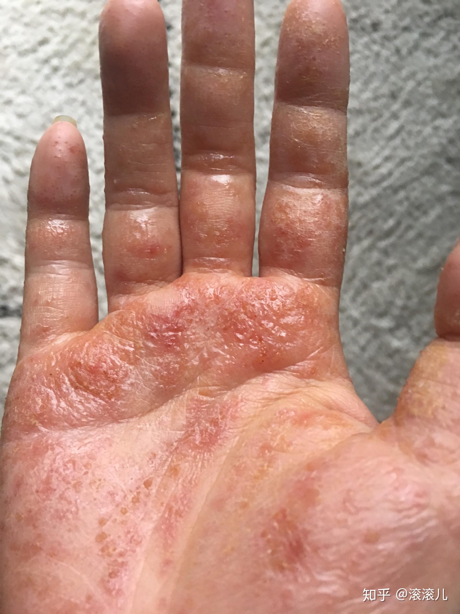 手部湿疹能根治吗? 