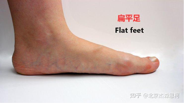为什么脚在放松的时候看出来是足弓脚,但一踩在地上就变实心脚?
