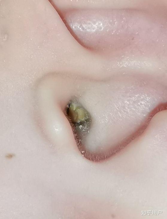 耳屎能大到什么程度