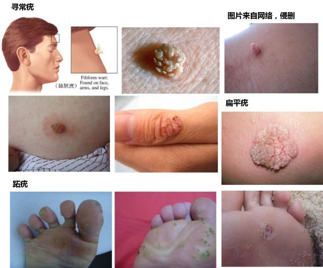 一张图教你辨别疣常见的皮肤疣有哪些