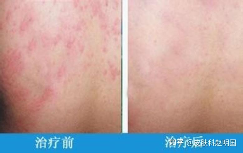 樟脑丸导致的过敏性湿疹该如何根治? - 知乎