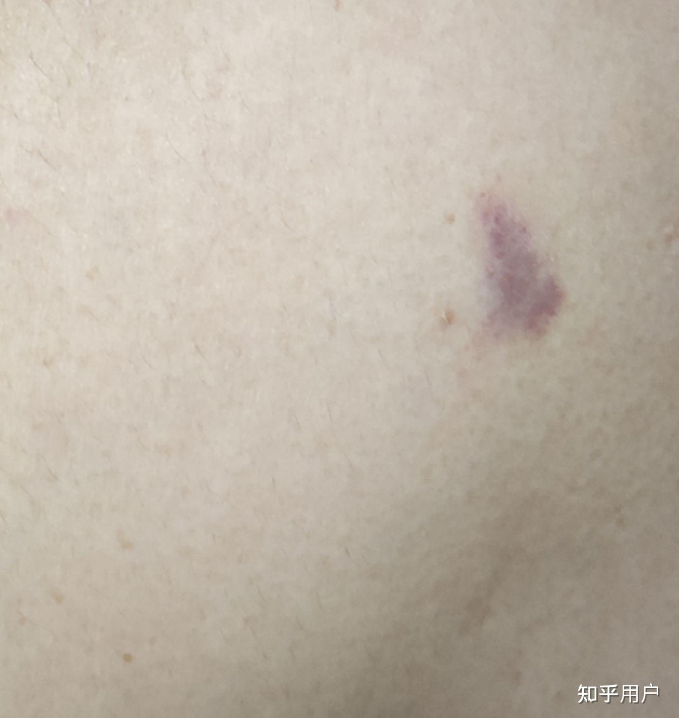 这是吻痕吗?