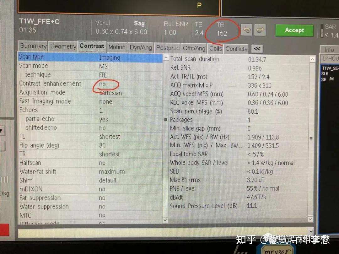 磁共振序列解析之——FFE序列分类 - 知乎