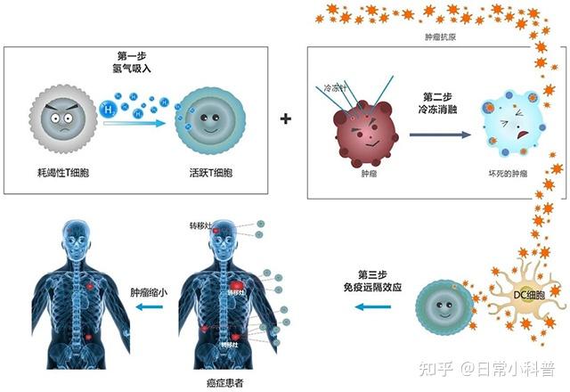 癌症的治疗不仅仅是消除肿瘤,更重要是让病人活下来—《冷冻消融-冷冻免疫-冷冻远隔效应》 - 知乎